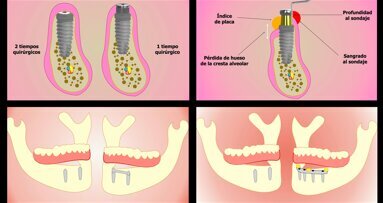 Carga inmediata o diferida en la mandíbula completamente edéntula