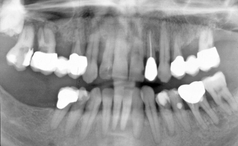 Fig. 1. Initial examination. Orthopantomograph