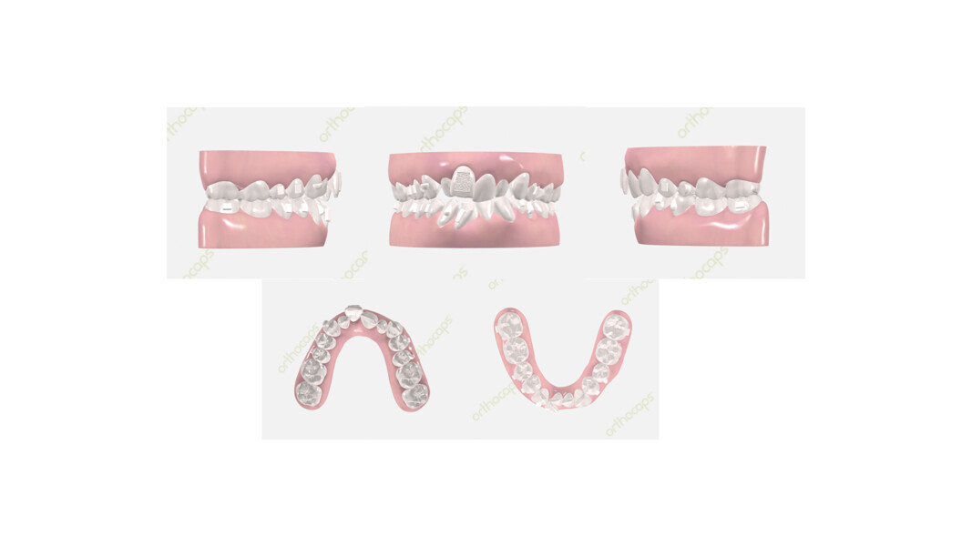 Figs. 11–15: Initial digital dental models.
