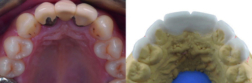 Fig. 8 : Wax-up, vue occlusale. 