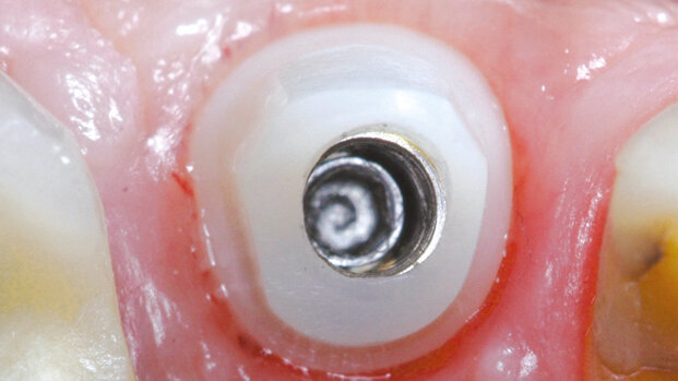 Gestione di una monoedentulia in area estetica in presenza di esostosi vestibolare: caso clinico