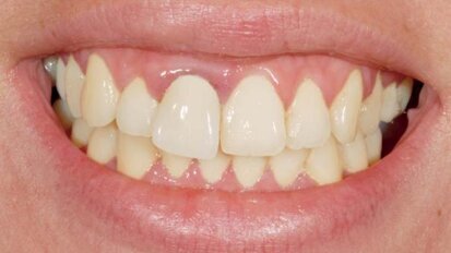 Implantacja natychmiastowa Ankylos® C/X