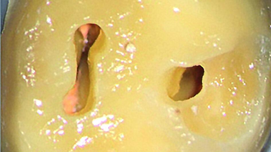 Préparer les cavités d’accès endodontique – Pour des résultats à long terme