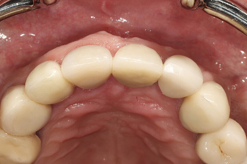 Fig. 12b: The occlusal view illustrated the cervical tissue volume and contours.