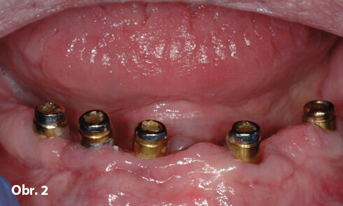 Klinický obraz pacienta. Za povšimnutí stojí opotřebení kovových abutmentů z důvodu uvolnění nylonových matric kvůli rotaci náhrady ve funkci.