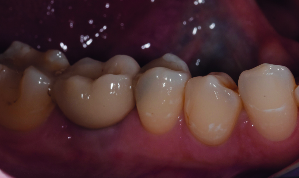 Fig. 26 : Intégration de la couronne d’usage, avec vérification de l’occlusion, en vue vestibulaire. 