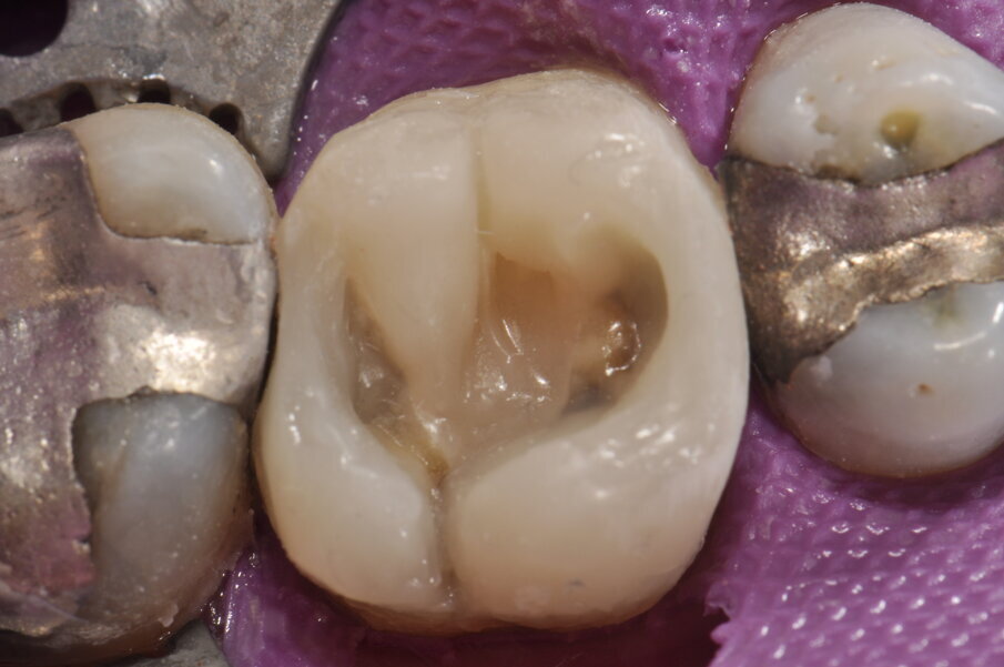 Fig. 8: Conformación de las crestas marginales después de acabar de modelar las paredes bucales y linguales de las cúspides.