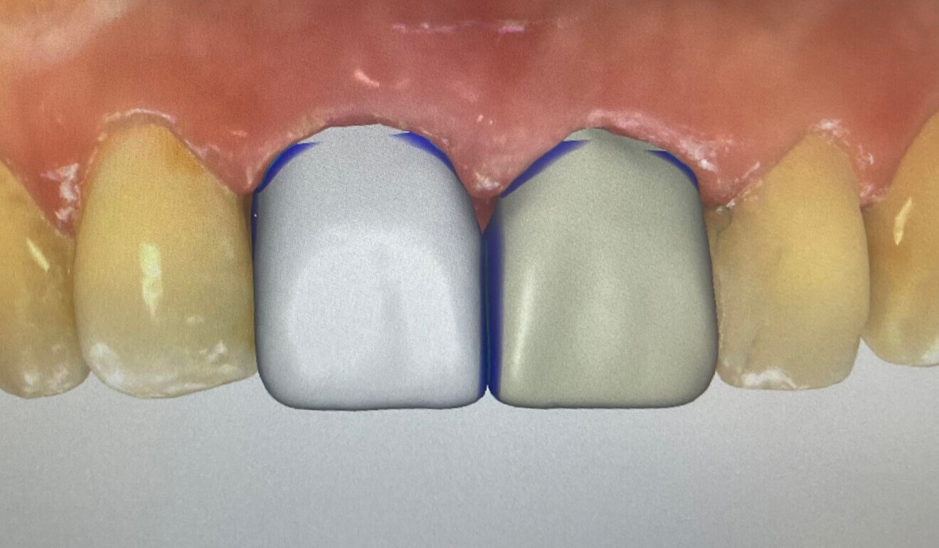 Fig. 5: Designing of the two crowns.