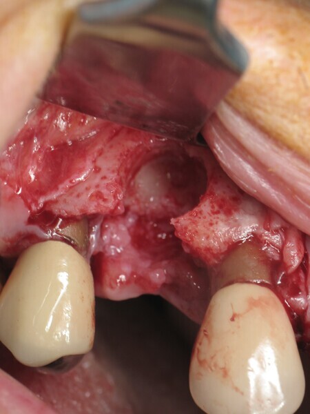 Fig. 4 : Calibrage du défaut. 