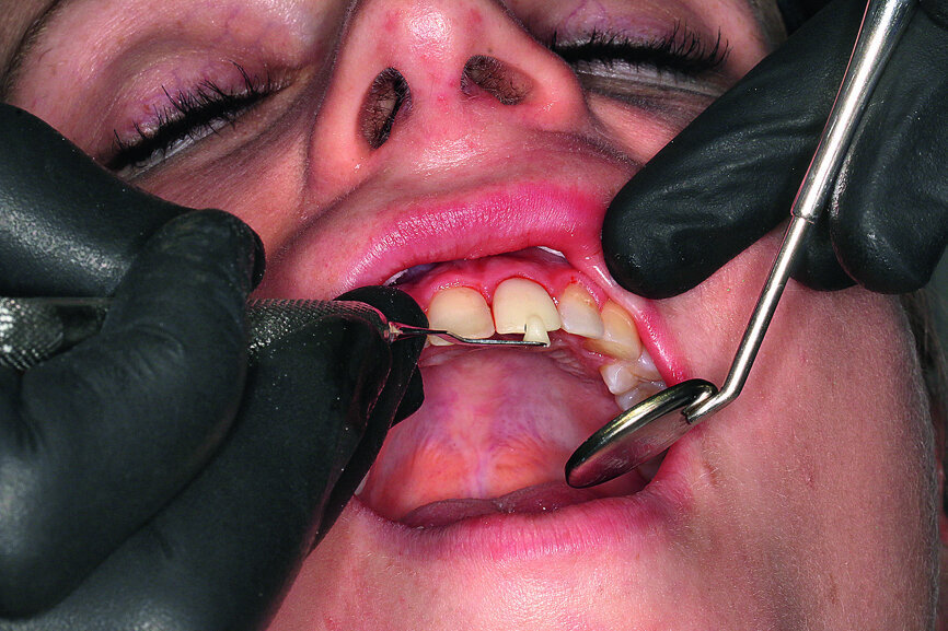 Fig. 13: Sealing the screw channel with composite.