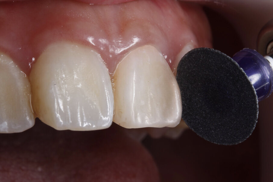 Fig 9: Line angles created with Super-Snap violet disks