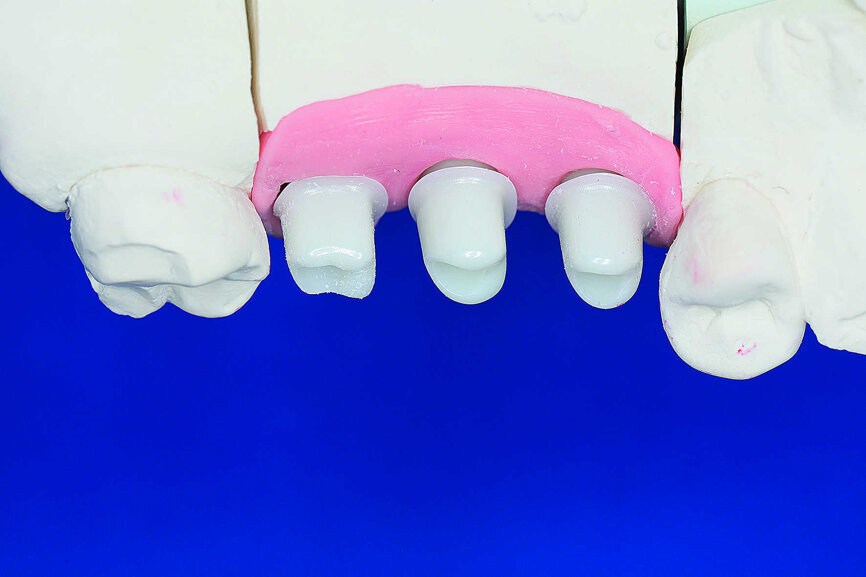 Fig. 21 : Piliers sur le modèle. 