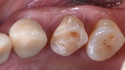 La customizzazione Cad-Cam delle cappette di guarigione negli impianti post-estrattivi