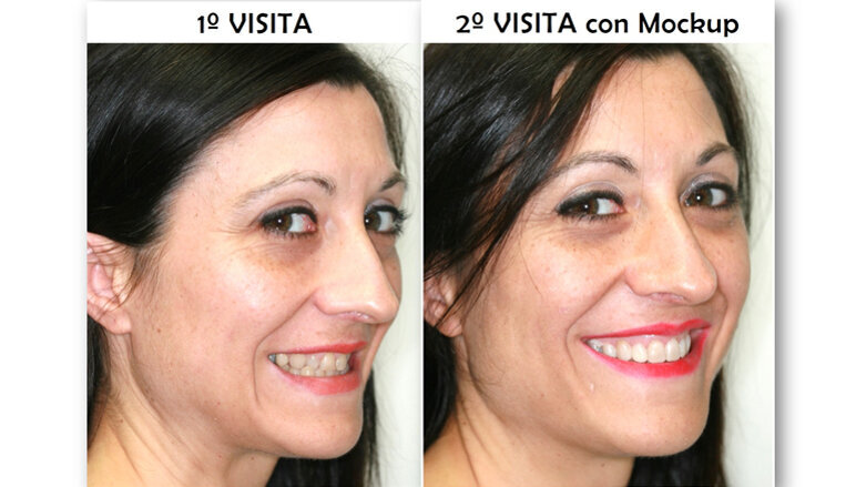 Diseño de sonrisa y neuromarketing