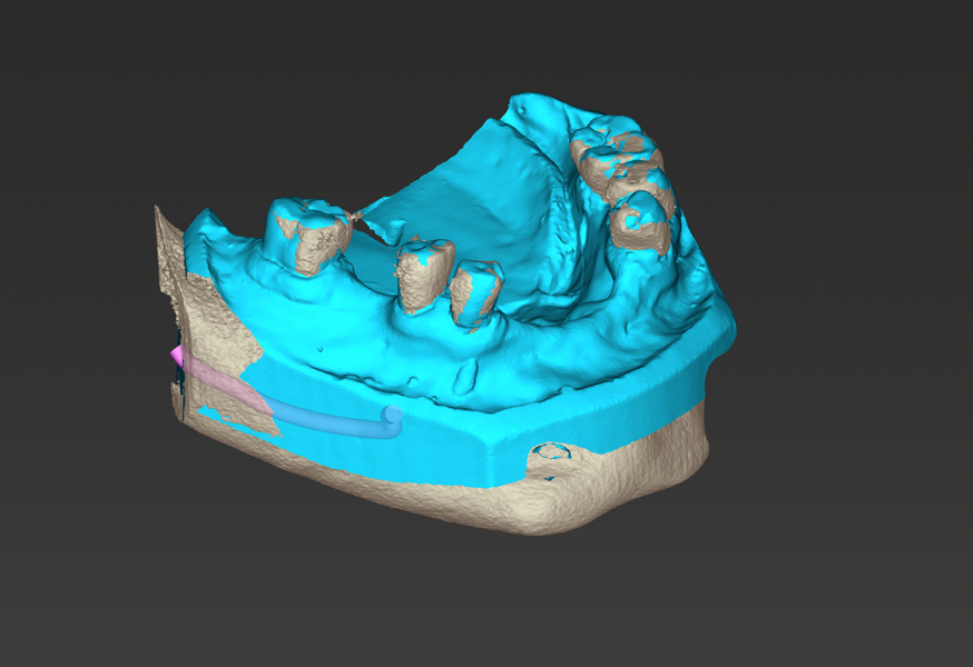 coDiagnostiX merging of DICOM and STL files