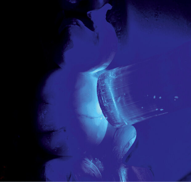 Fig. 10: Final curing. Excess luting material was removed beforehand (quarter technique). 