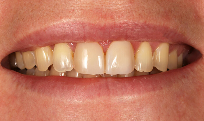 Fig. 4: The mock-up corresponded to the aesthetic expectations of the patient.