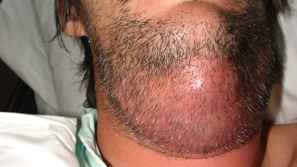 Manejo y prevención de infecciones odontogénicas