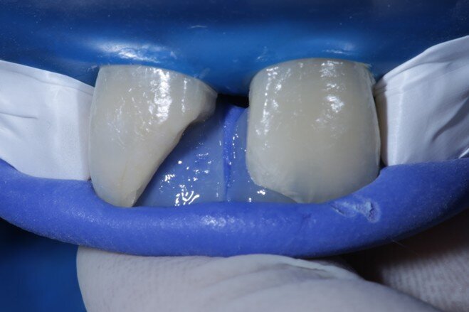 Fig 7 Enamel shade merged with the teeth