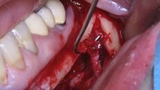 Naše zkušenosti s technikou kostní piezochirurgie po 15 letech klinického používání