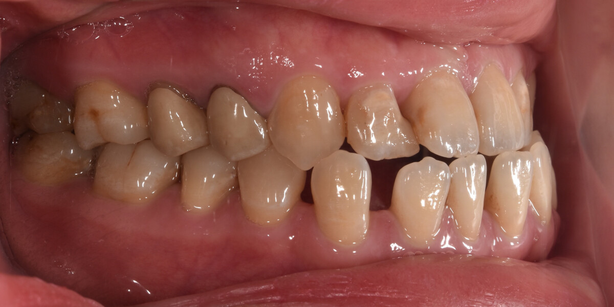 Fig. 2a–e: Initial intra-oral photographs.