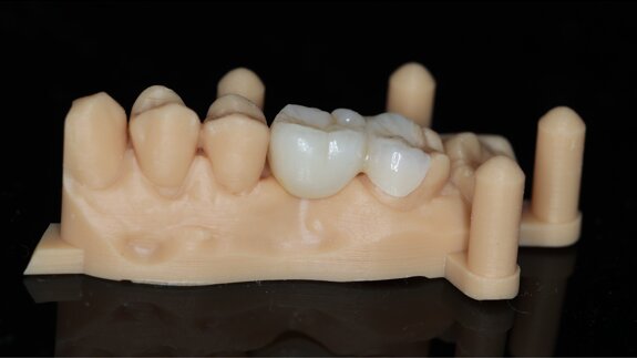 Casus: De posterior cantilever adhesiefbrug