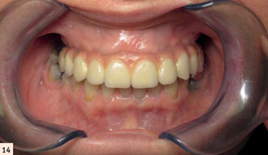 Bridge céramométallique transvissé avec une fausse gencive.