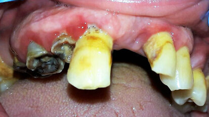 L’igienista dentale e il paziente diabetico: Motivazione e istruzioni di igiene orale
