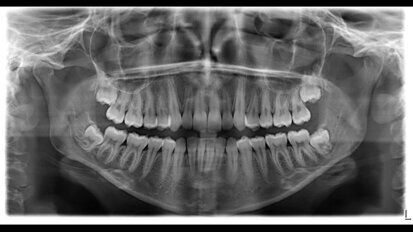 Trattamento di un paziente adulto con affollamento lieve-moderato mediante NOXI