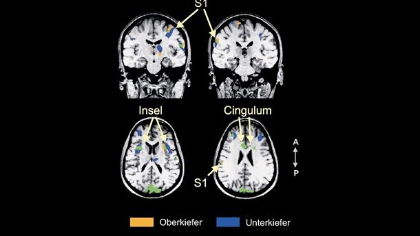 Gehirn kann Zahnschmerz kaum lokalisieren