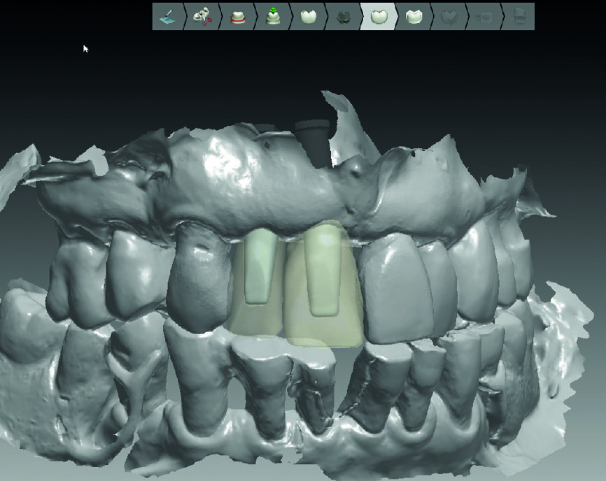Fig. 14 : Design des piliers implantaires anatomiques aux couronnes. 