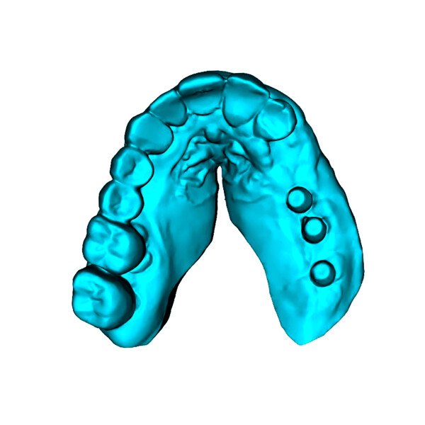 Figs. 9a–c: Merging of the intra-oral scan dataset (a) with the CBCT reconstruction (b) to verify implant positioning (c) relative to the proposed prosthetic design.