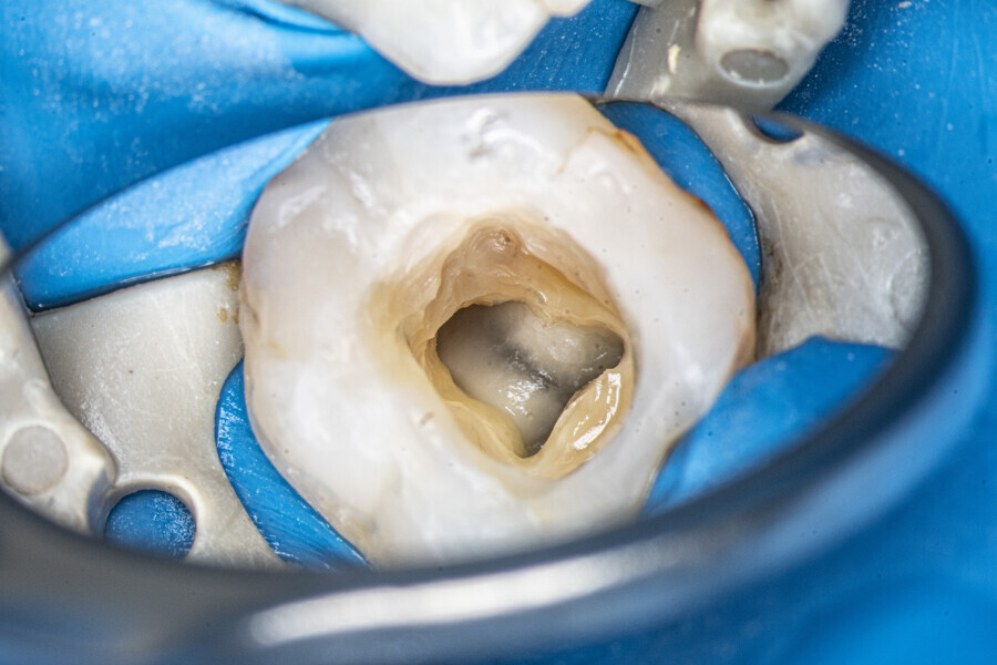 Fig. 29: The mandibular first molar after removal of the temporary restoration.