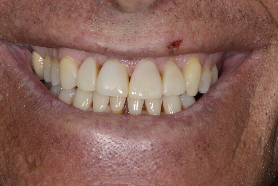 Figs. 20a–f: Temporary direct restoration with composite to change the anterior tooth proportions and to close the space due to arch expansion achieved after first orthodontic treatment phase.