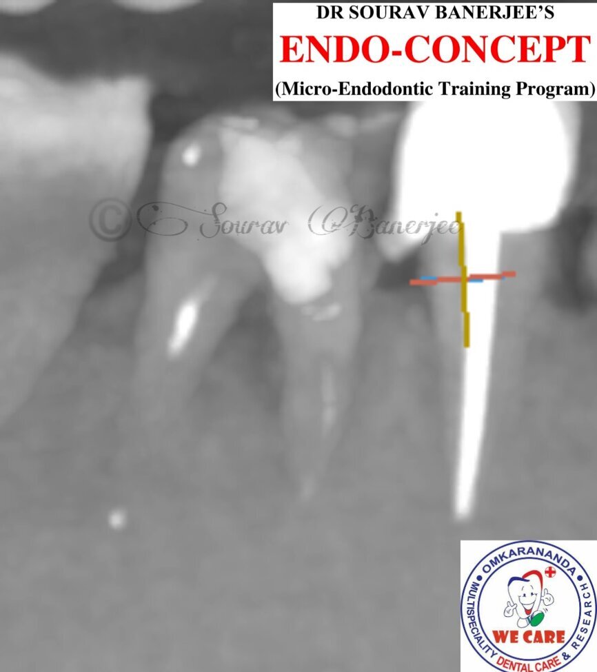 Fig.2g: Pre-op CBCT images of tooth #46: No obturation material in the distal and mesiobuccal canal (a); scanty obturation of the canals and breach of the floor of the pulp chamber, no obturation beyond a few millimetres down the orifice (b & c); radiolucency in the furcation area and periapical region of both roots (d -g).