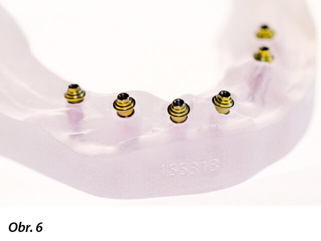 Multi Unit abutmenty fixované na replikách implantátů. 3D tiskem zhotovený model.