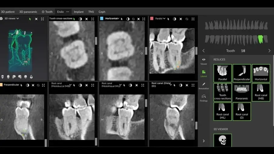 Фиг. 9 Ендодонтският режим на DTX Studio Clinic в различни профили за анализ на случая.
