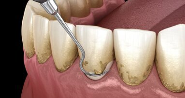 Periodontal healing may improve overall well-being via improved gut health
