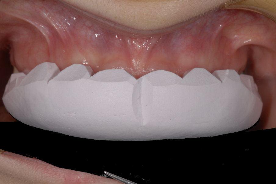 Fig. 13 - Il prototipo stampato in bocca.