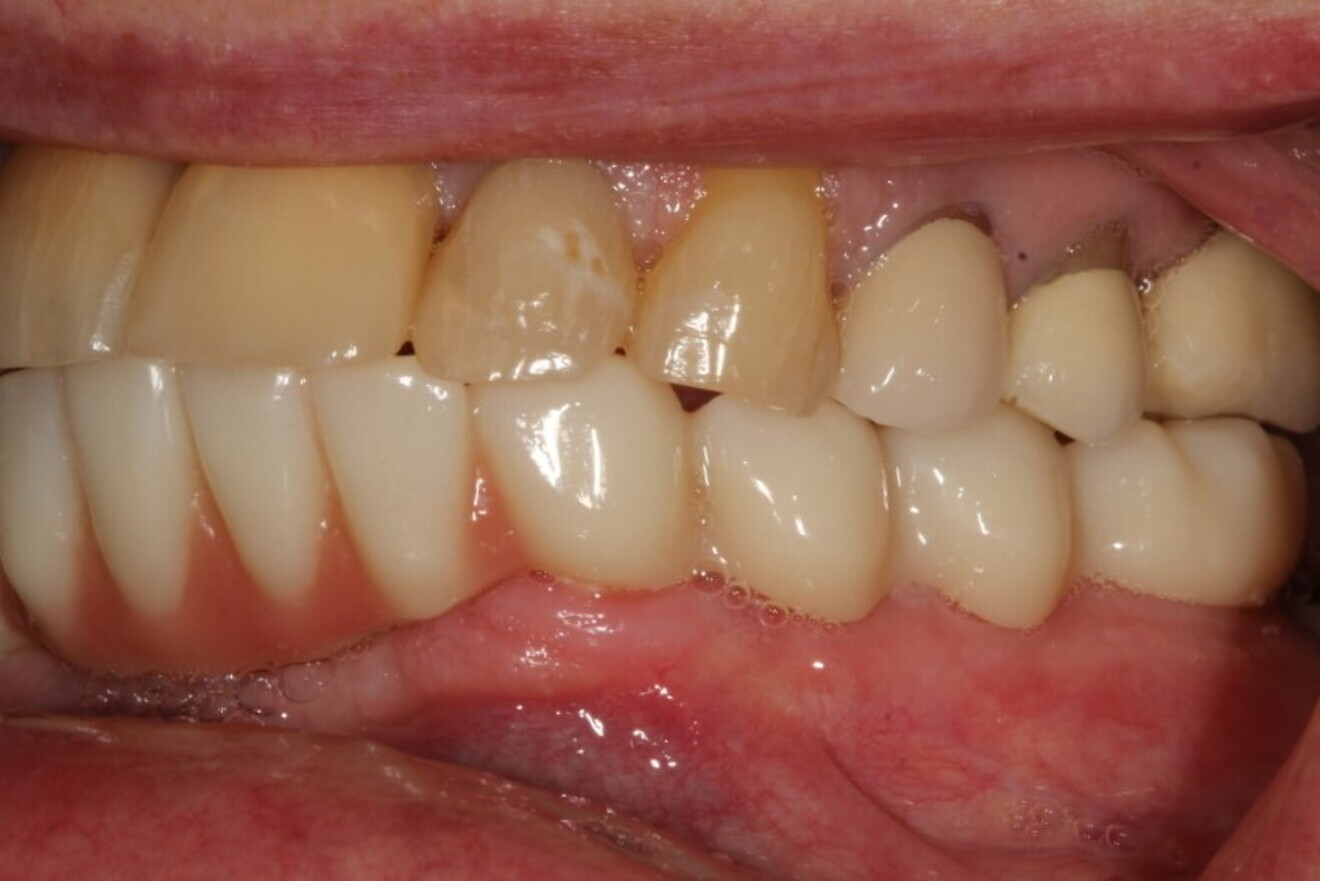 Figs. 18a & b: Final restoration in function.