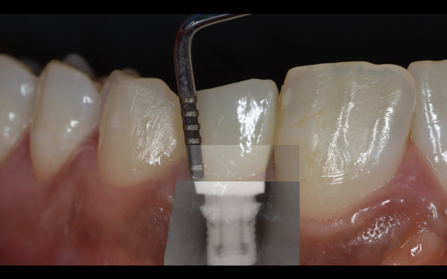 Fig. 2_Perdita di osso per cause iatrogene, la capsula non è congrua con il moncone.