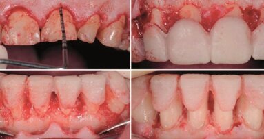 Sposoby odbudowy zębów z silną abrazją