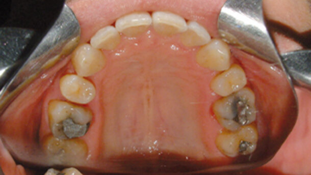 Posibilidades terapéuticas del CA® Clear-Aligner