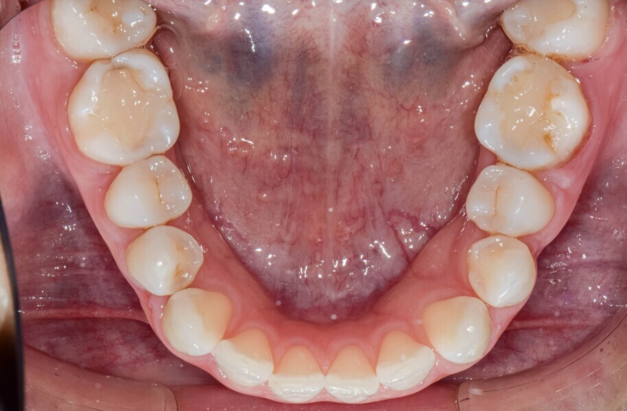 Fig. 13: Correction of the rotated premolar occurred in 12 weeks. Had the same tooth been rotated with just a composite attachment, it would have taken 38 weeks at the programmed 2° of rotation per aligner.
