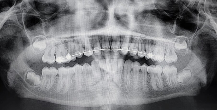 Figg. 2a, 2b: Rx-OPT iniziale di una paziente di anni dieci con trasposizione caninopremolare 1.3-1.4 e ritenzione canina dell’elemento 23(A); Rx-OPT in corso di trattamento della stessa paziente, in cui è mostrata la risoluzione ortodontica con mantenimento dei denti trasposti nel primo quadrante (B).