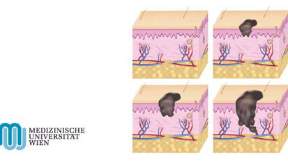 Hautkrebs: Protein hemmt Bildung von Metastasen
