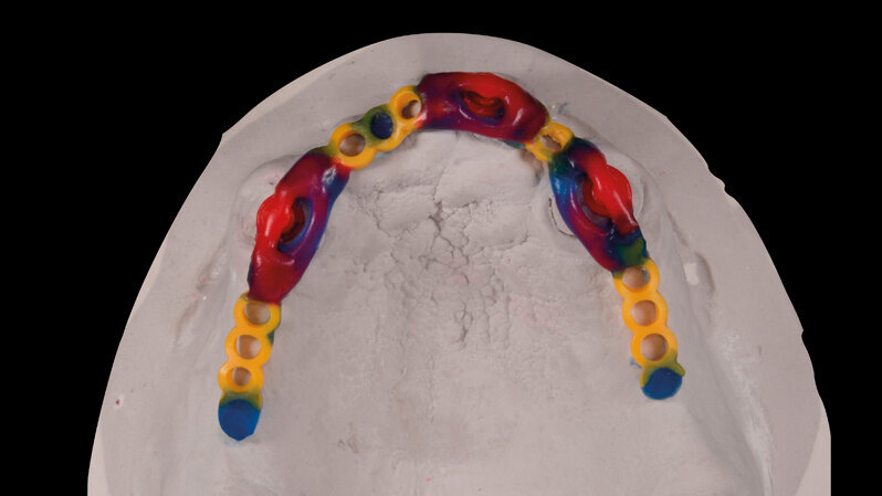 Il nuovo volto della protesi totale