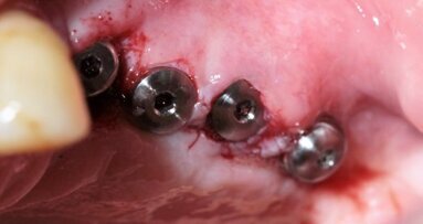 Zastosowania indywidualnej siatki tytanowej w augmentacji wyrostka zębodołowego szczęki z wykorzystaniem rhPDGF – część II