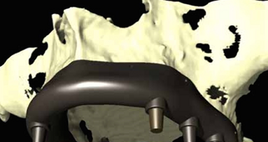 La revolucion de las barreras oclusivas