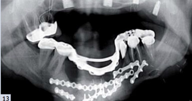 ADF 2015 : Implants et prothèse amovible partielle, un mariage de raison ?